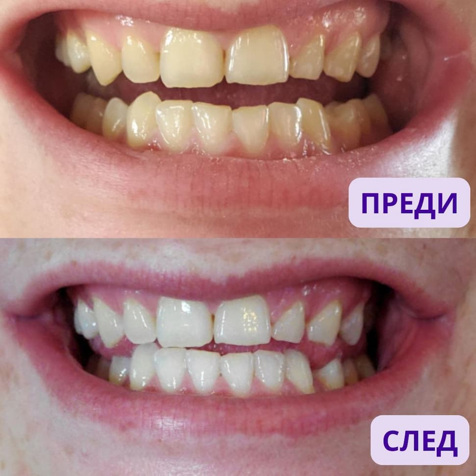 WhiteMe Mega Pack - Pap+ (лентички) + V34 (серум за избелване) + Паста (подарък на случаен принцип)